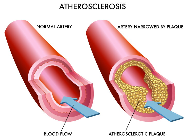 eggs and cardiovascular health atherosclerosis