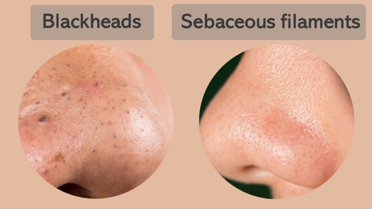 Blackhead Removal blackheads sebaceous filaments