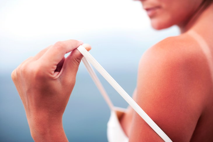 Sun Poisoning & Sunburn, Differences and Treatment sunburned woman