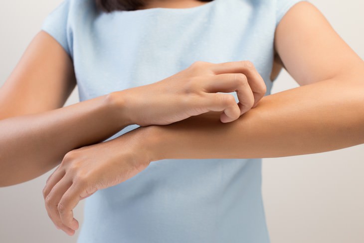 Sun Poisoning & Sunburn, Differences and Treatment eczema