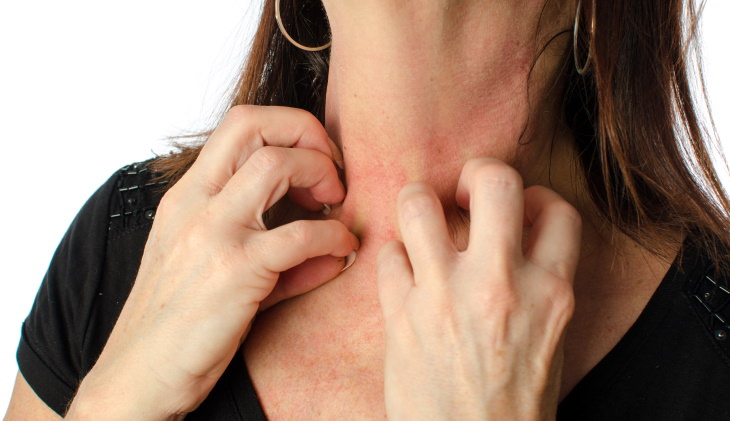 Stress Rash woman scratches rash on her neck