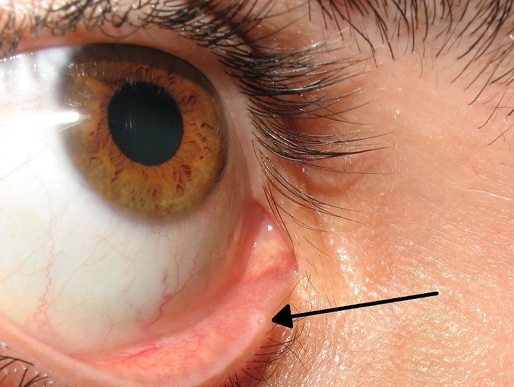 Little-Known Body Parts,  Eyelid hole