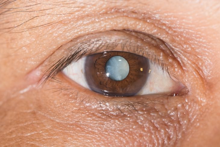 Surprising Reasons for Adult Eye Color Change cataract