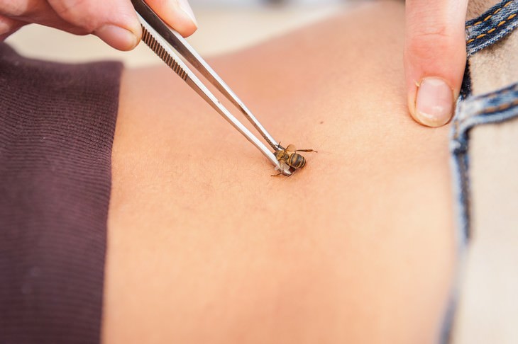 The Serious Dangers of Bee Sting Therapy 