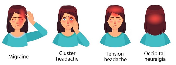 Occipital neuralgia, infogrpahic