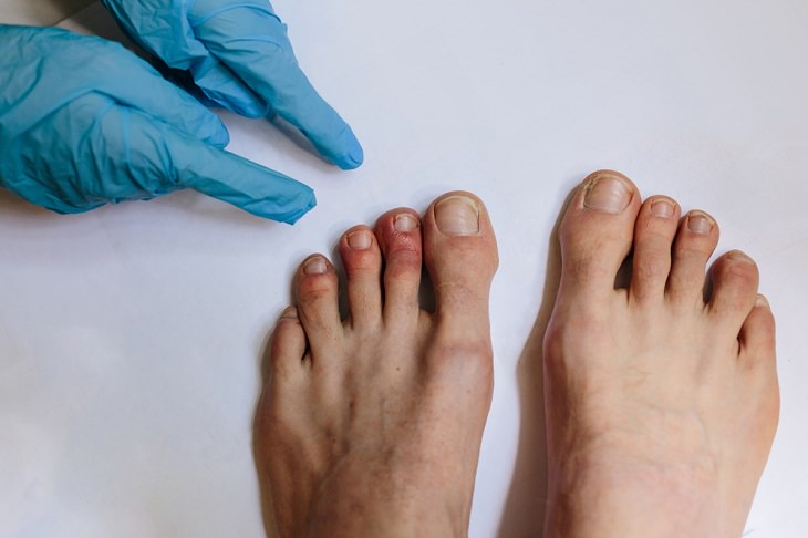 COVID Toes, examination