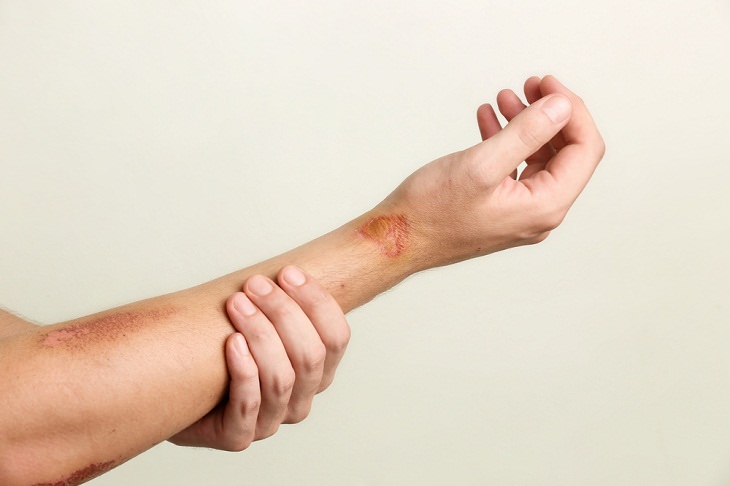  Vitamin D Deficiency, wounds