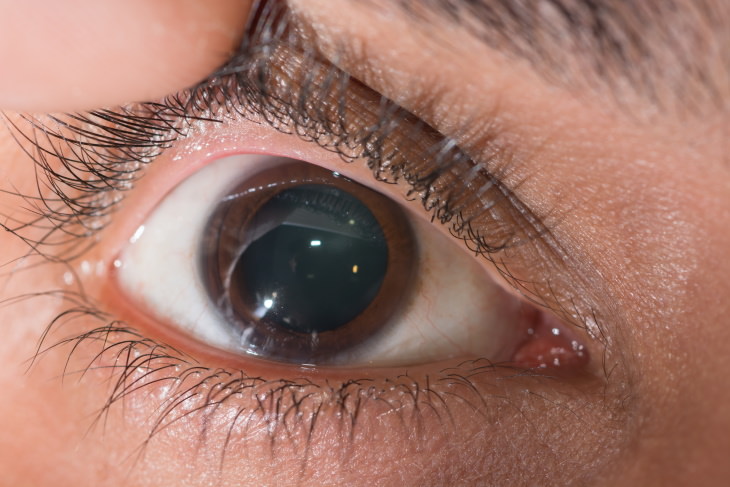 Dilated Pupils Causes eye exam