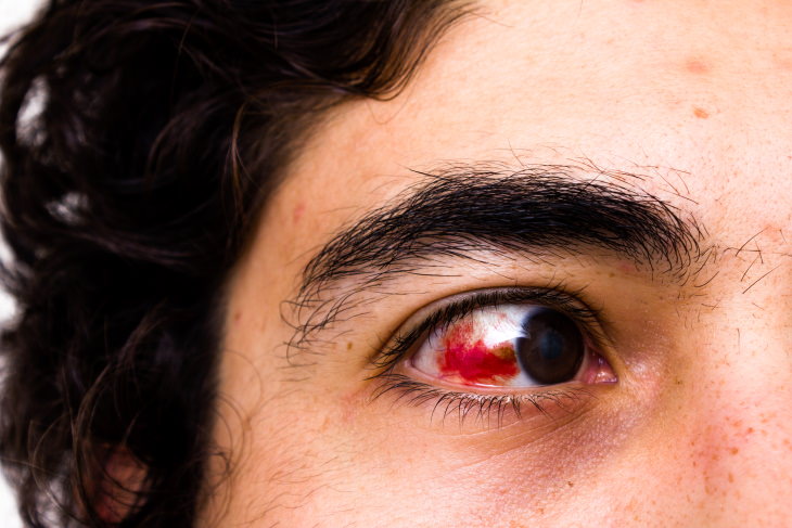 Dilated Pupils Causes Eye injury