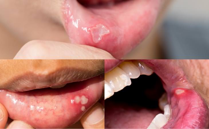 Canker Sores