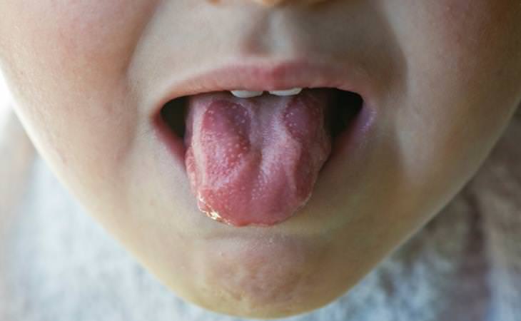 Geographic Tongue 