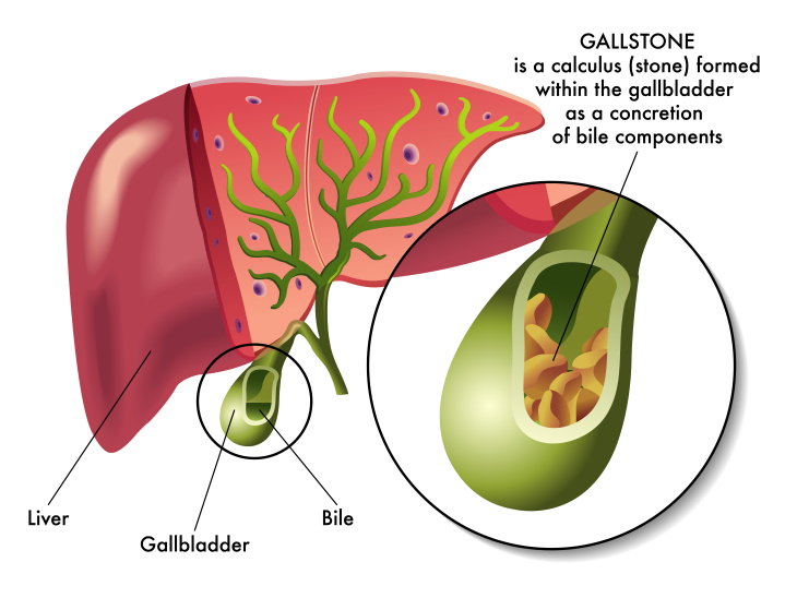 Causes of Postprandial Pain Gallsone