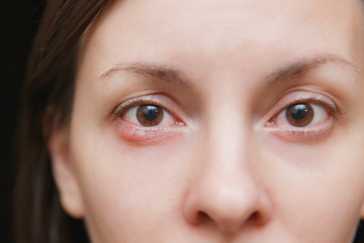 Eye Infections Stye