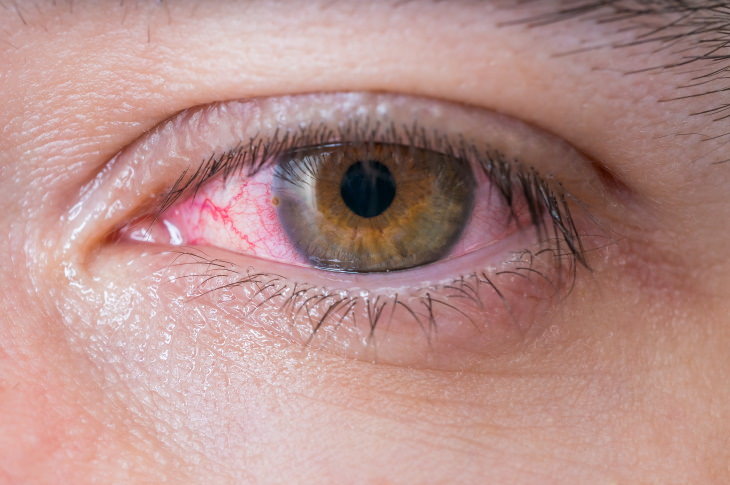 Eye Infections Conjunctivitis