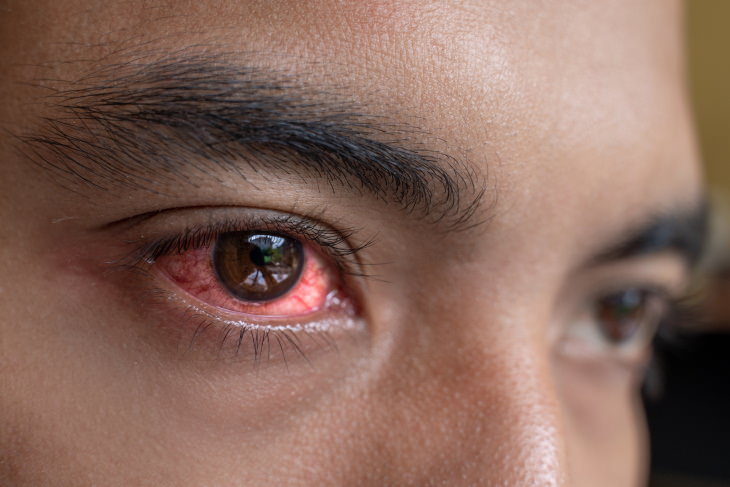 Eye Infections man with red eyes