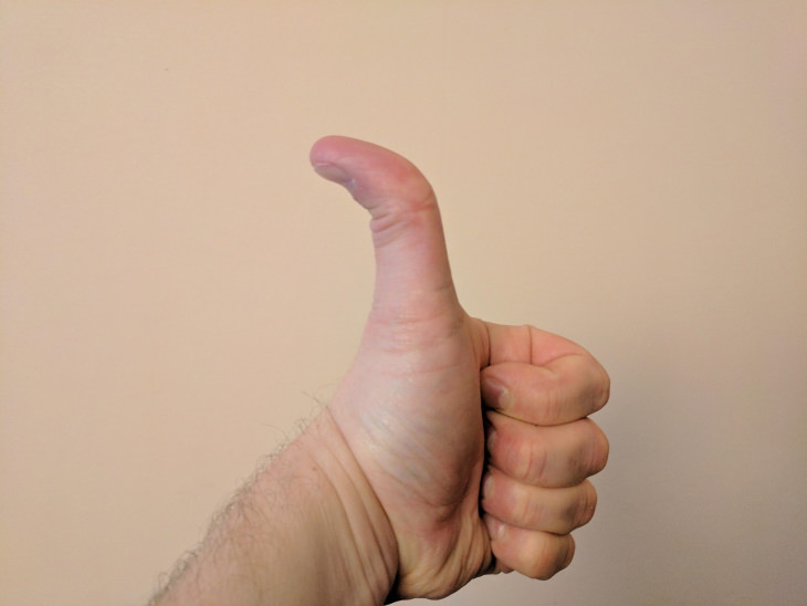 rare genetic traits Hitchhiker's thumb