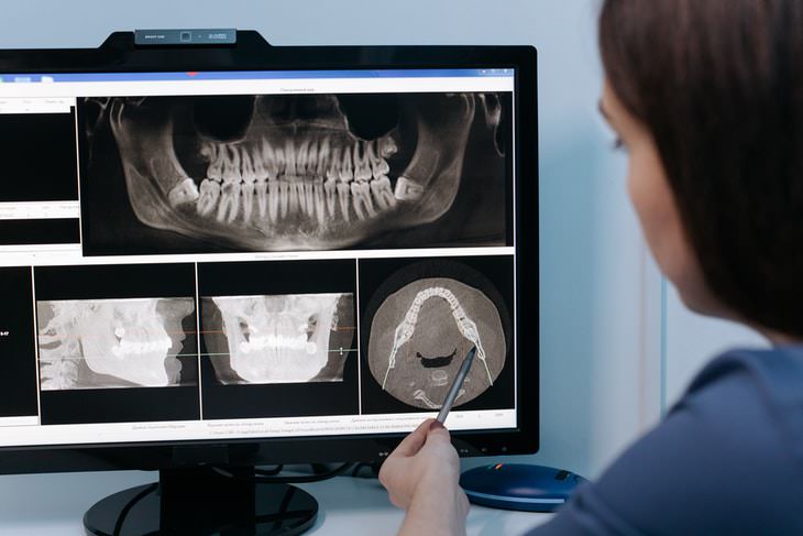 rare genetic traits tooth X ray