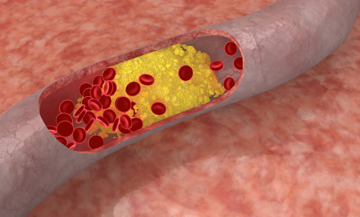 Cholesterol Myths plaque in blood vessel