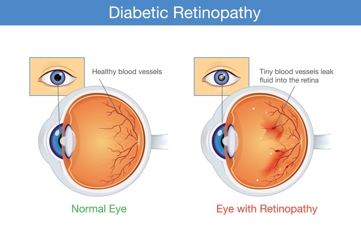 Causes of Tunnel Vision Diabetic retinopathy
