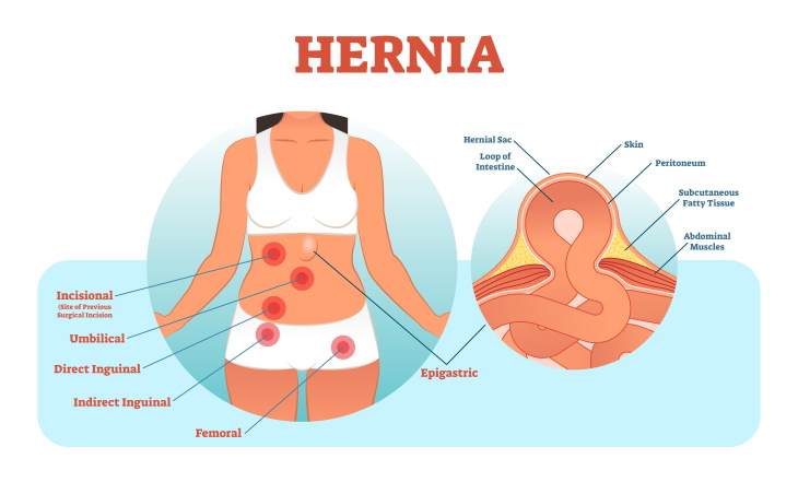 Types of Hernia general hernia