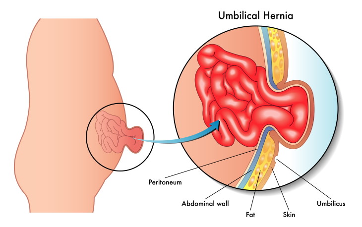 Types of Hernia Umbilical hernia