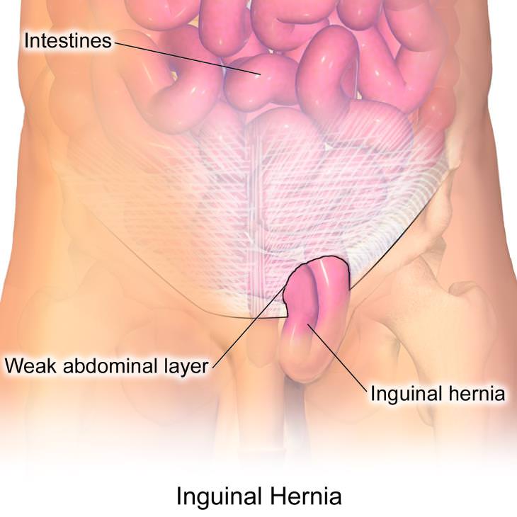 Types of Hernia Inguinal Hernia