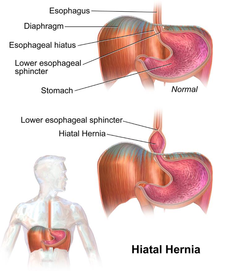 Types of Hernia Hiatal Hernia