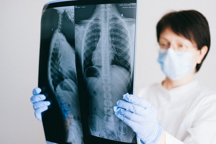 6 Types of Pneumonia doctor examining chest X ray