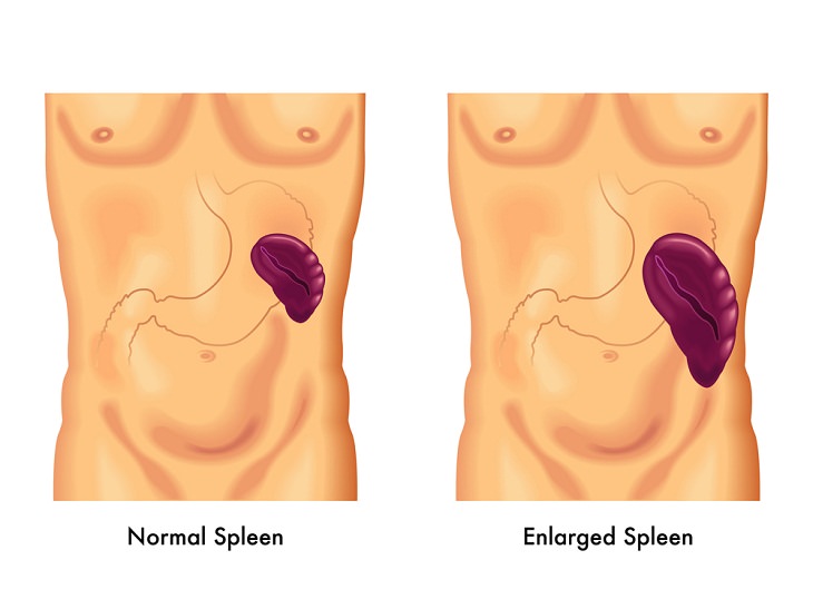 The Spleen, Enlarged Spleen