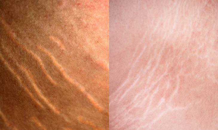 scar type  Stretch Marks