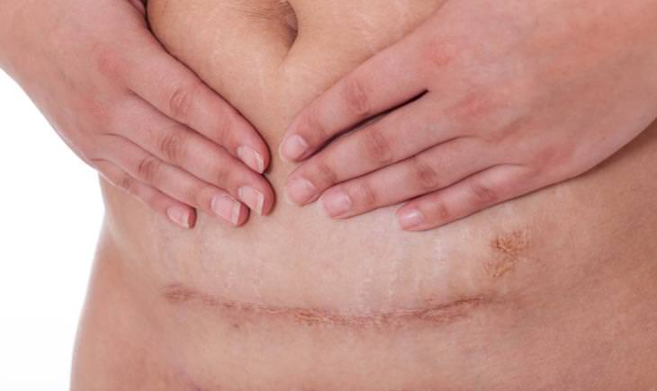 normal C section scar 