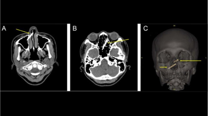 Strange Medical Cases of 2022 chopsticks in skull