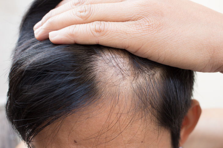 Iodine Deficiency Hair loss