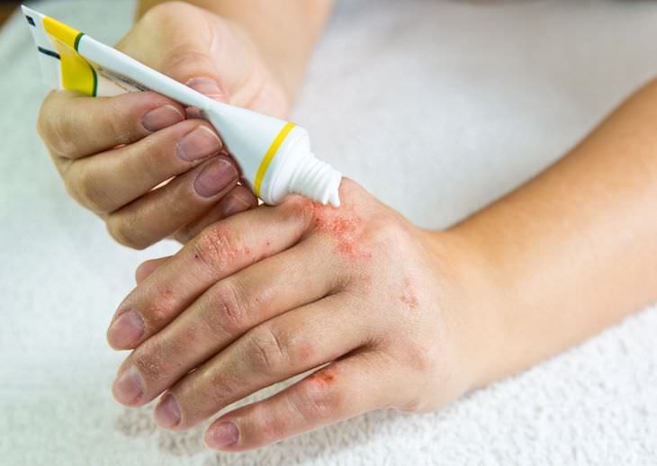 7 Causes For White Spots to Appear On Your Nails, psoriasis