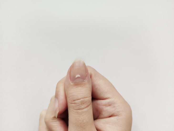 7 Causes For White Spots to Appear On Your Nails, white spot on nail