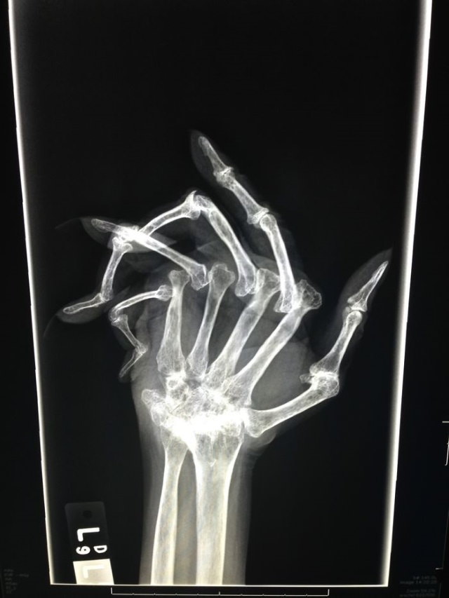 X-Rays advanced rheumatoid arthritis