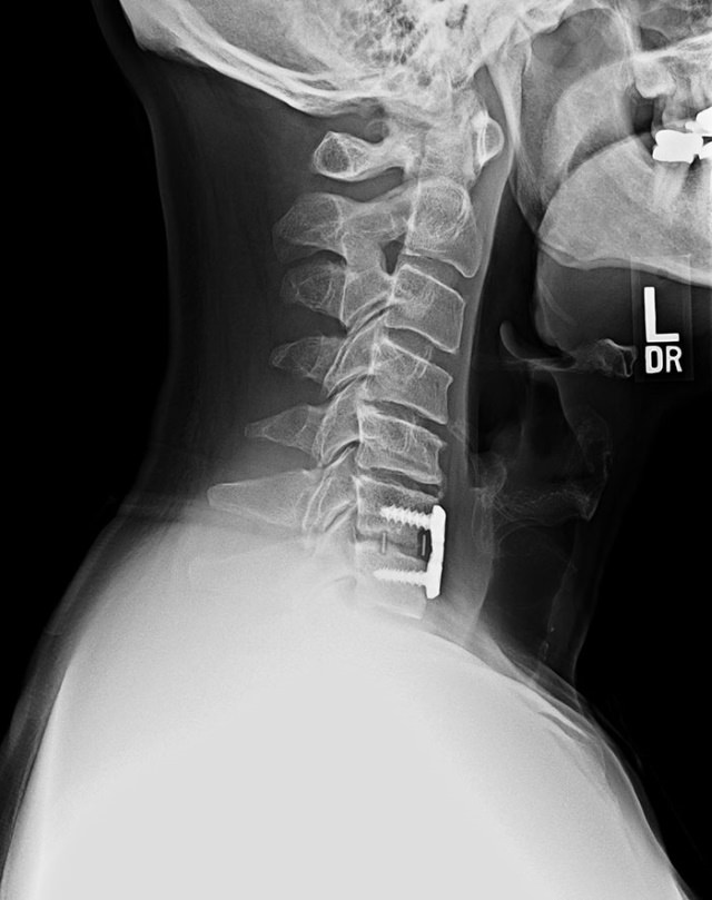 X-Rays bone growth device for cervical pain