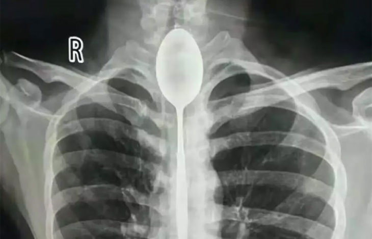 X-Rays spoon lodged in esophagus