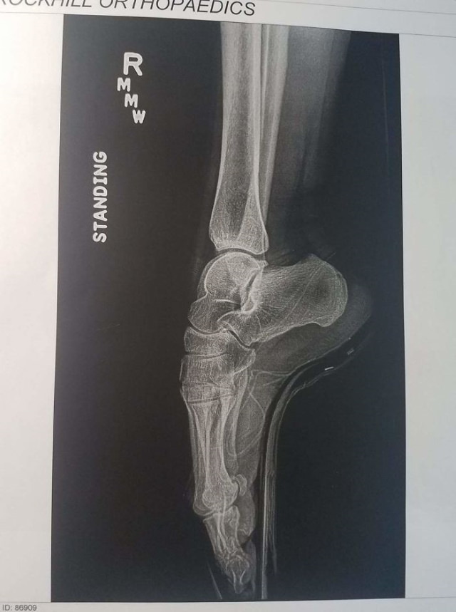 X-Rays  a ballerina's foot while on pointe
