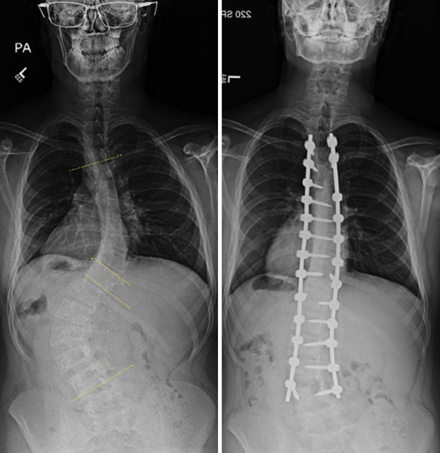 X-Rays scoliosis surgery