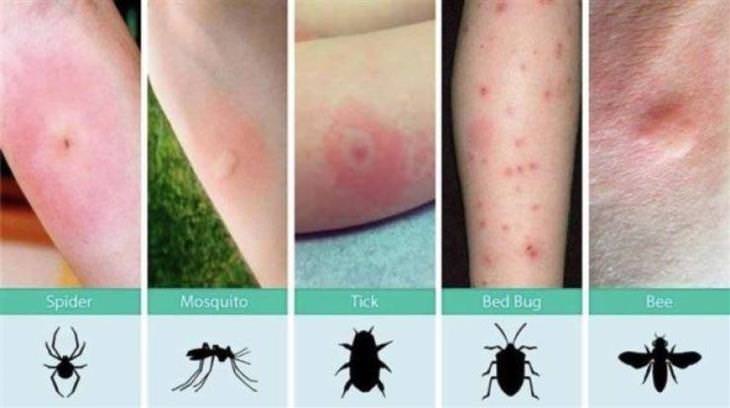 Practical Charts insect bites
