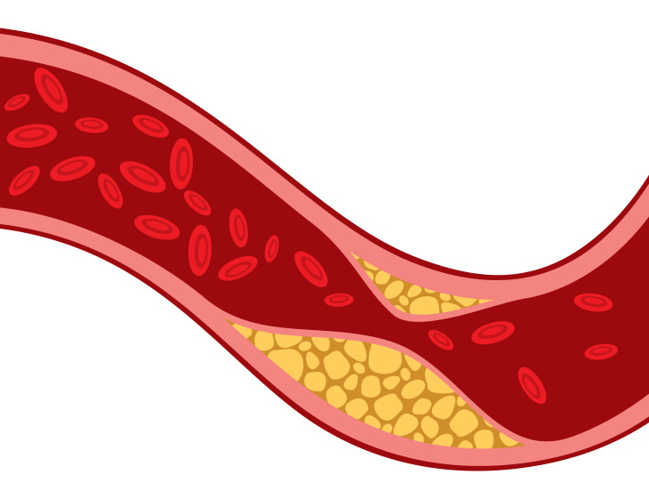 Hibiscus Tea atherosclerosis