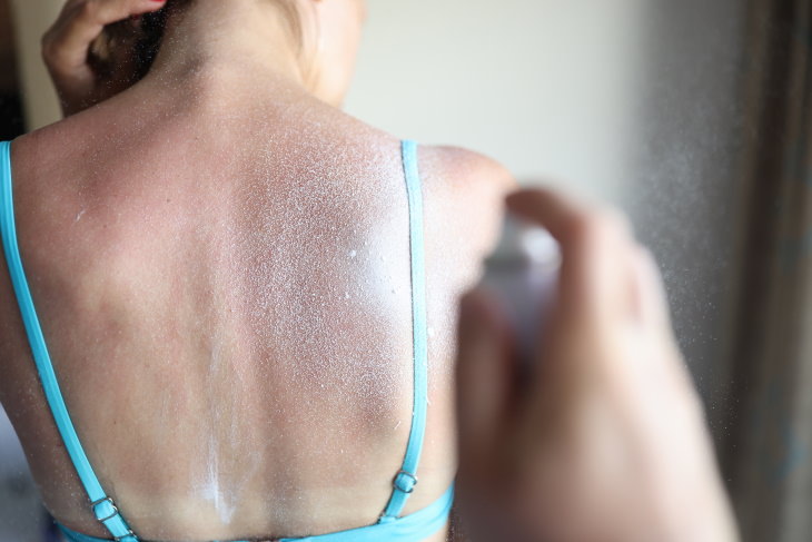 The Do’s and Don’ts of Healing a Sunburn woman with sunburn