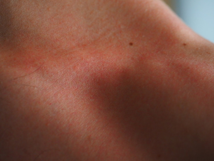 The Do’s and Don’ts of Healing a Sunburn Redness