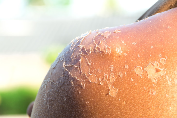 The Do’s and Don’ts of Healing a Sunburn Peeling