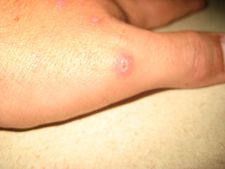 fresh brown recluse bite