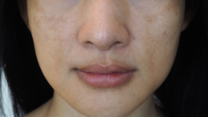 Summer Skin and Hair Problems Melasma