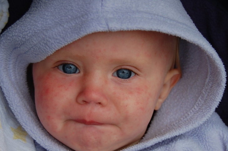Ancient Ailments Measles