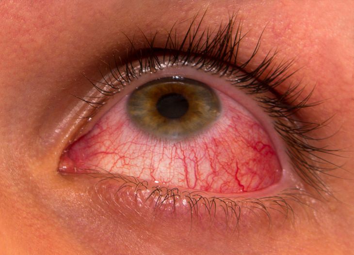 Eye Issues, pandemic, Corneal abrasions