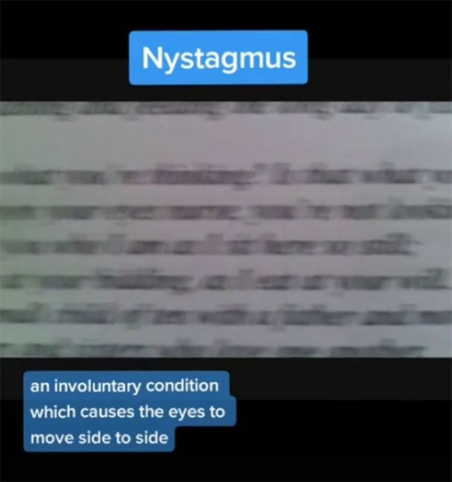 How People With Vision Limitations See the World Nystagmus